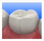 Tooth-Colored Fillings